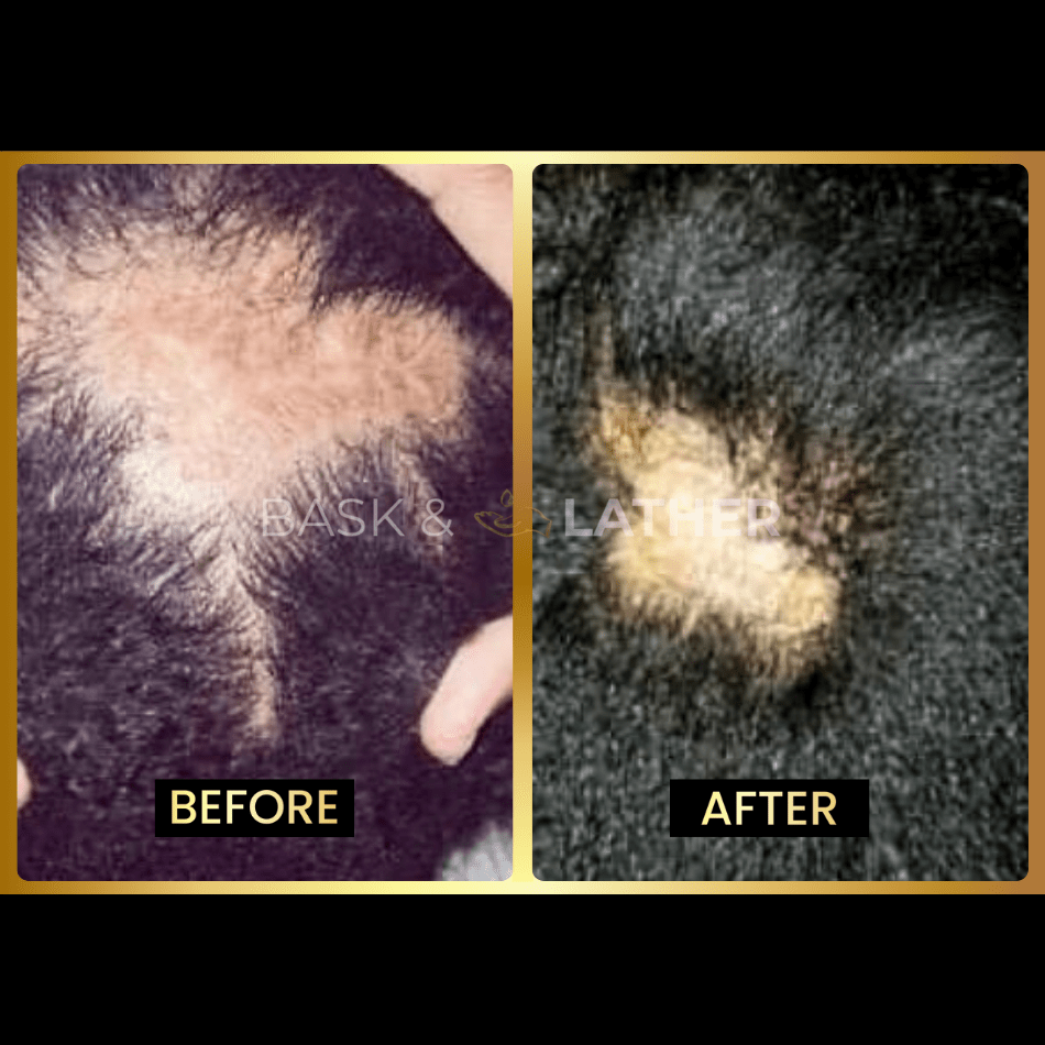 Scalp Stimulator- 3 Month Supply